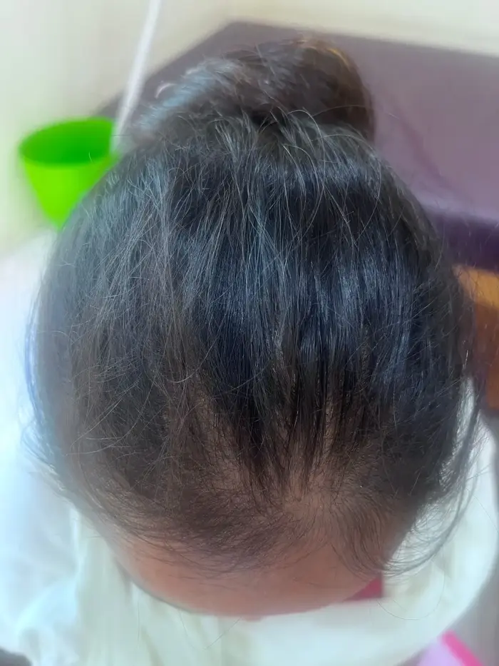 Female Pattern Baldness case 5 after treatment